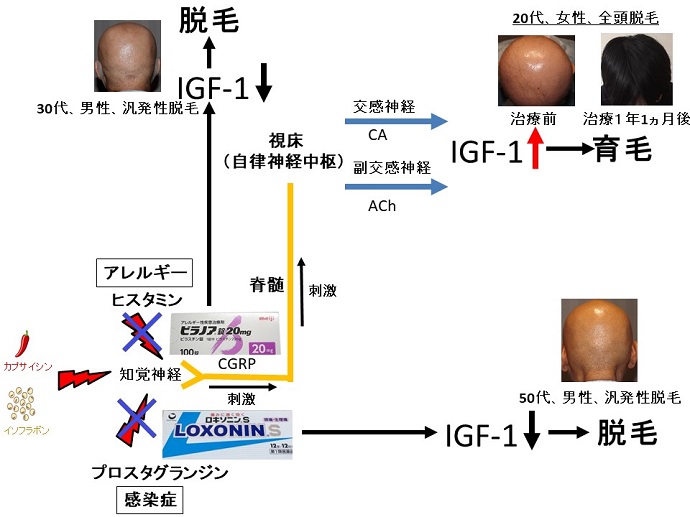 円形脱毛症　病院